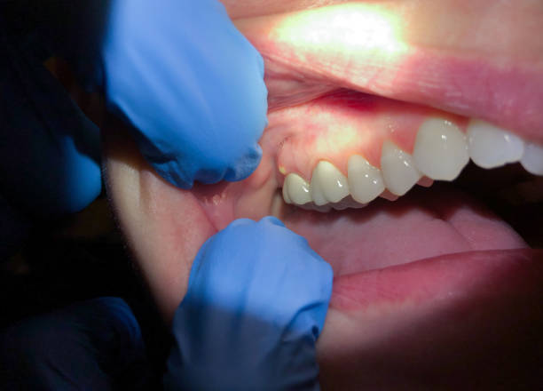 Best Emergency Dentist for Lost Fillings or Crowns in Reston, VA